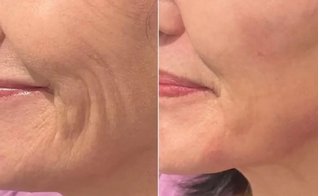 Light-Based Skin Rejuvenation
