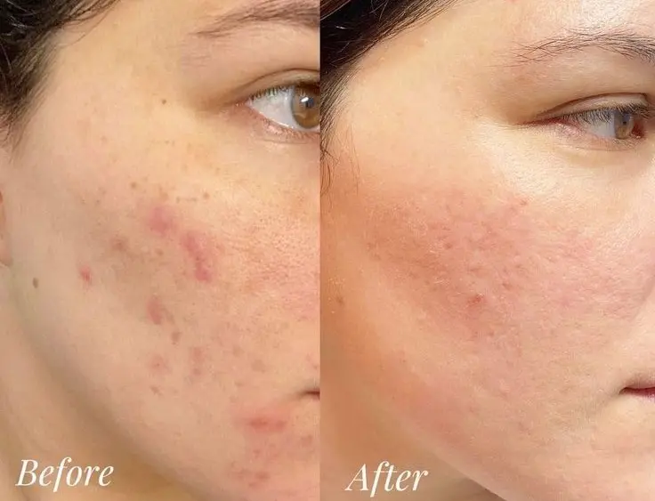 Microdermabrasion for Acne Scars