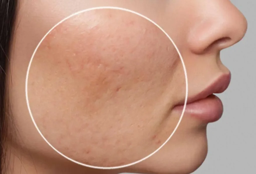 HydraFacial to Treat Acne Scars