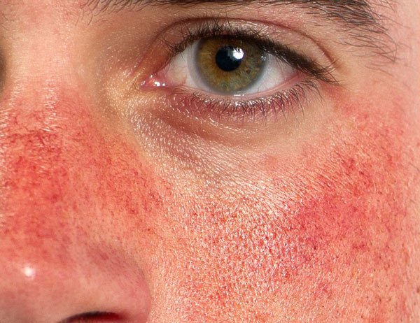 Rosacea