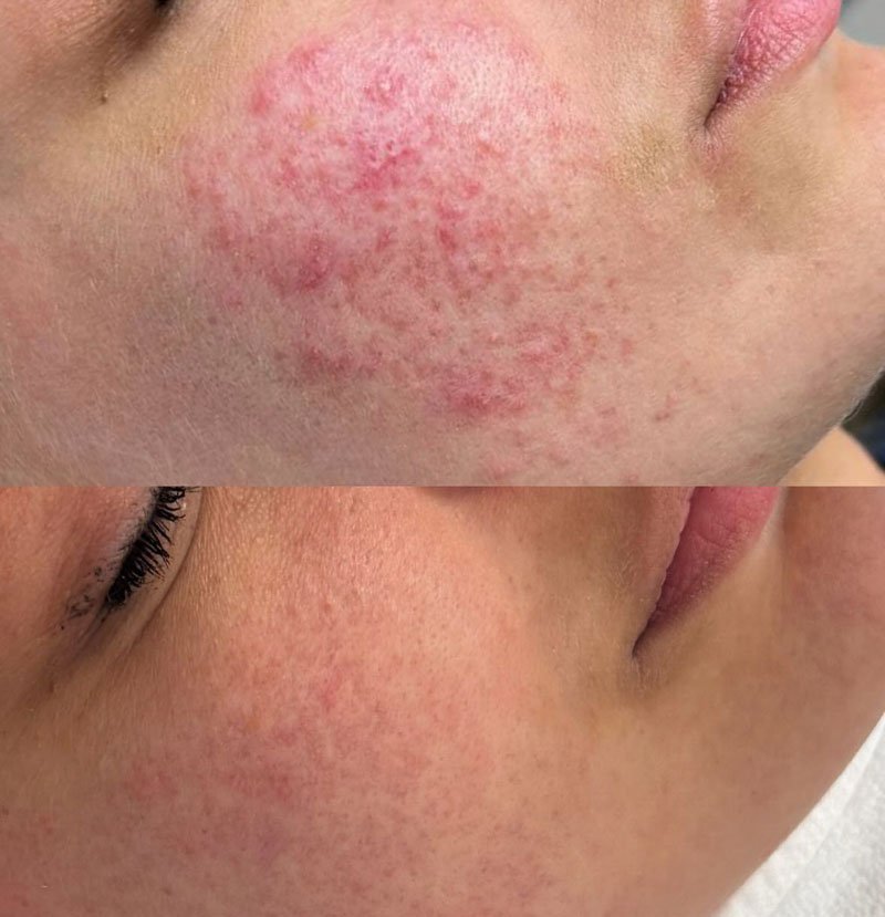 Rosacea