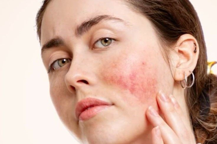 Rosacea