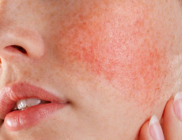 Rosacea