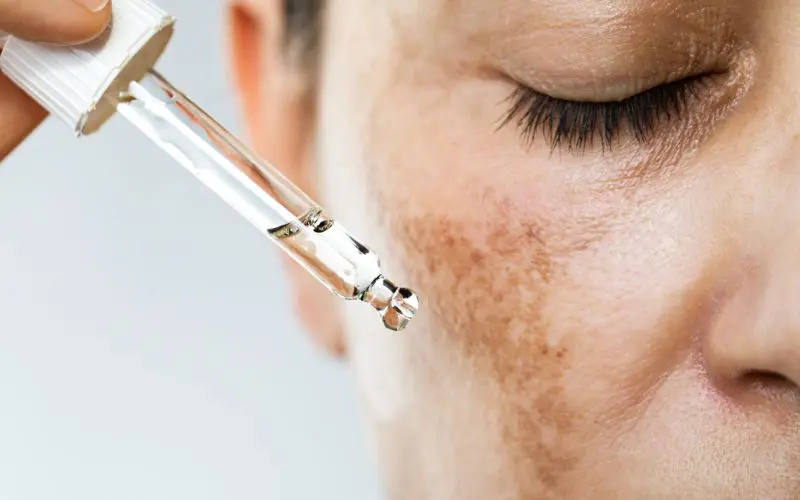 melasma skin condition