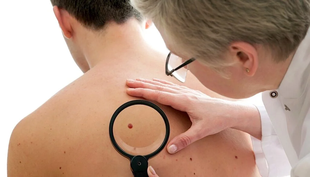 The Skin and Melanoma