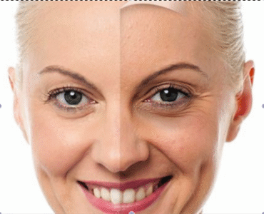 Premature Skin Aging