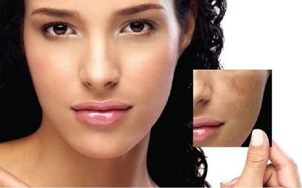 melasma skin condition