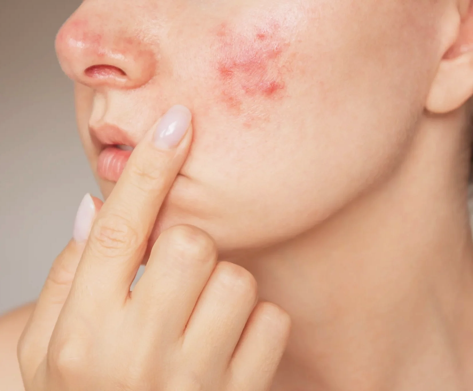Common Signs And Symptoms Rosacea