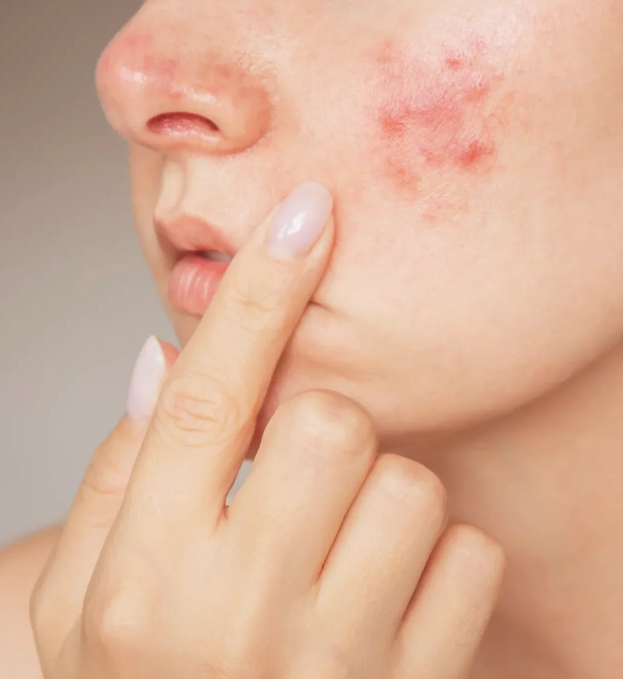 Common Signs And Symptoms Rosacea