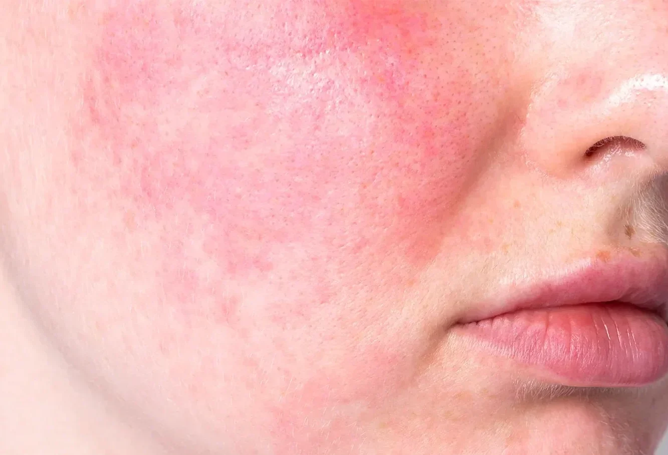 Reduce Rosacea Redness And Capillaries