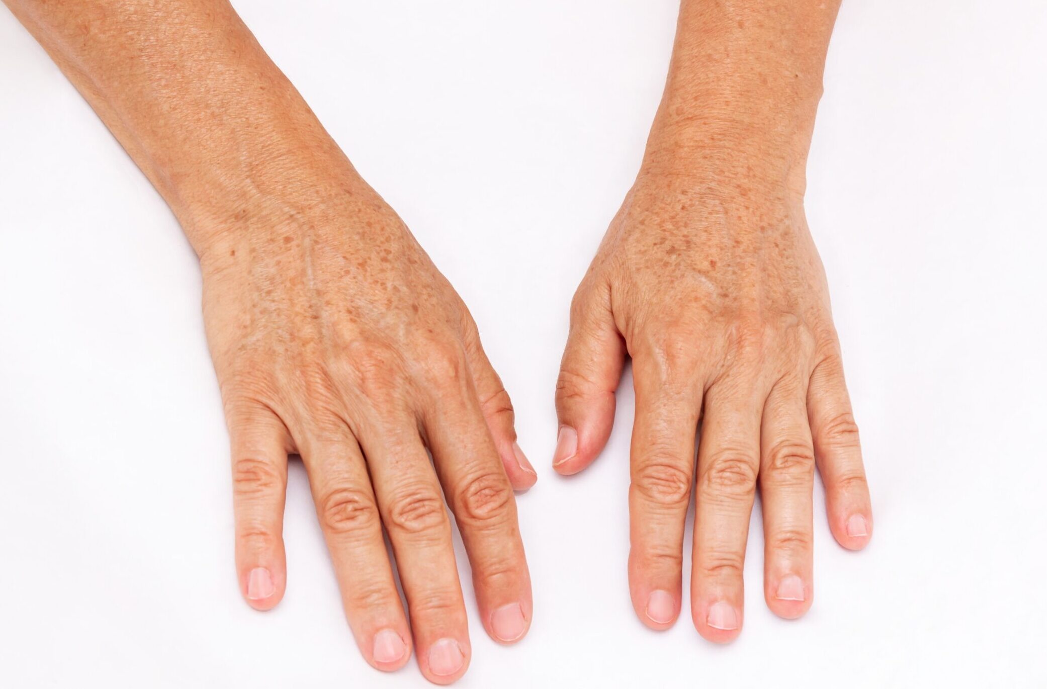 The,Hands,Of,Elderly,Woman,With,Pigmented,Spots,Isolated,On