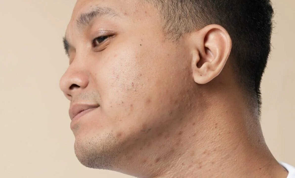 Acne scarring in Melbourne