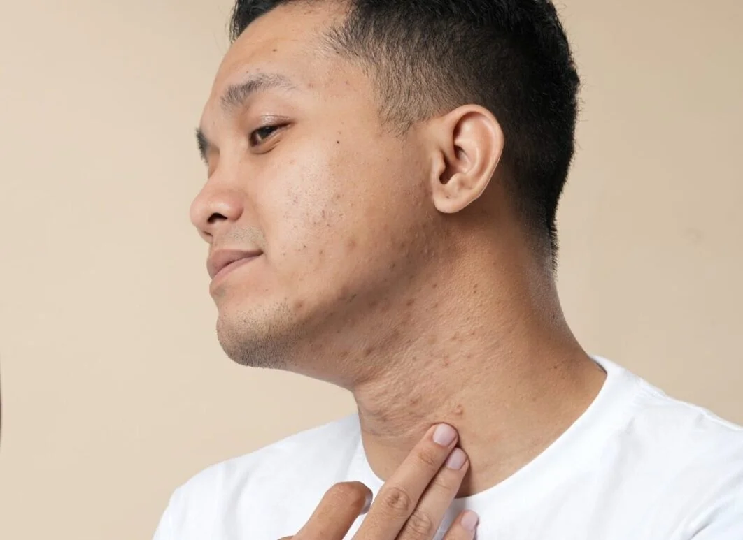 Acne scarring in Melbourne