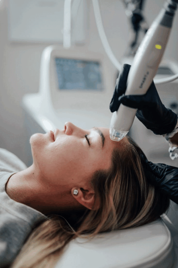Radiofrequency Microneedling in Melbourne