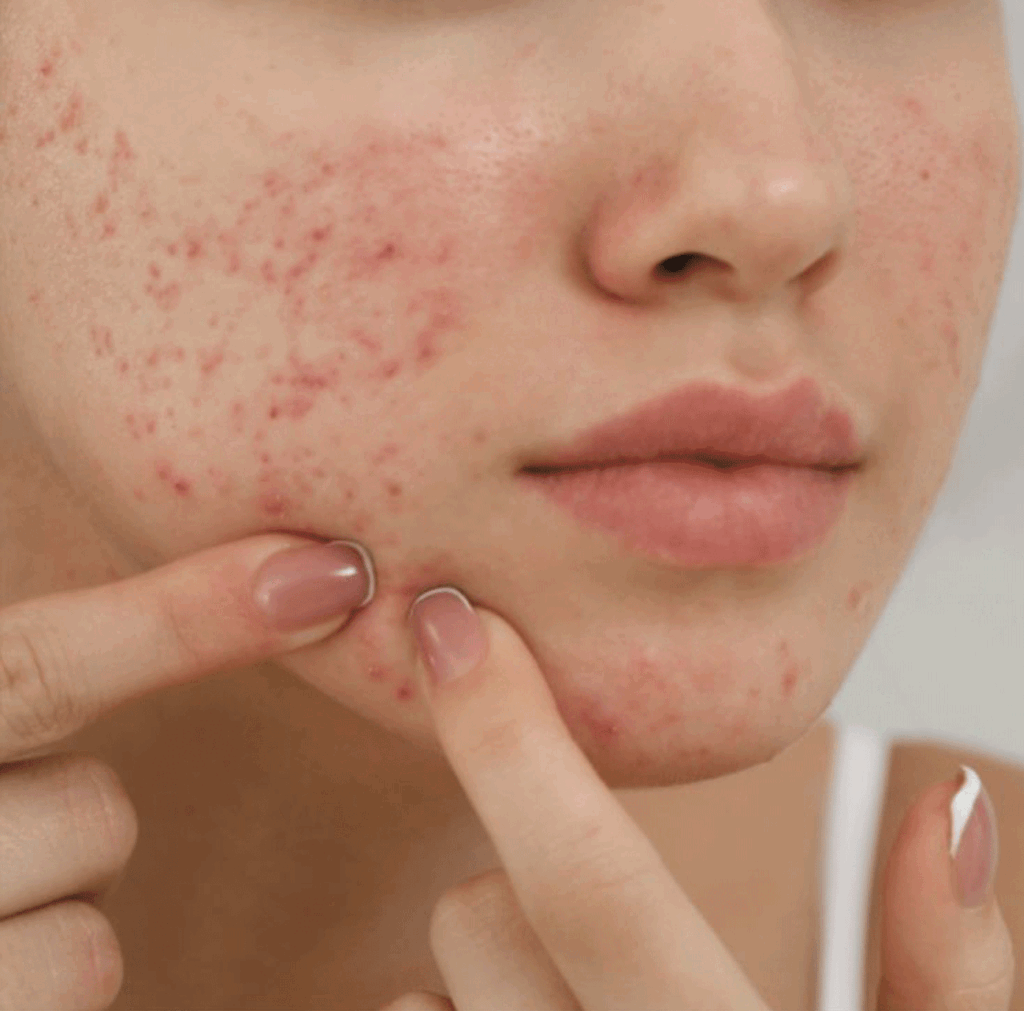 Acne scarring in Melbourne