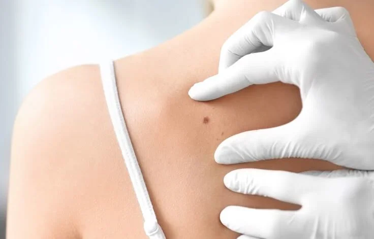 Skin tag and mole removal in Melbourne