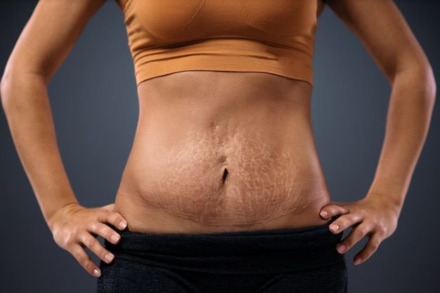 Scar treatment during pregnancy