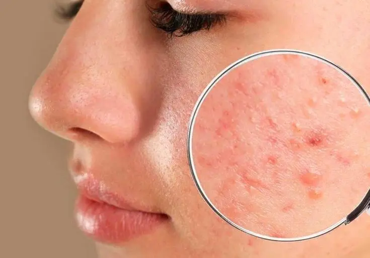 laser acne scar treatment