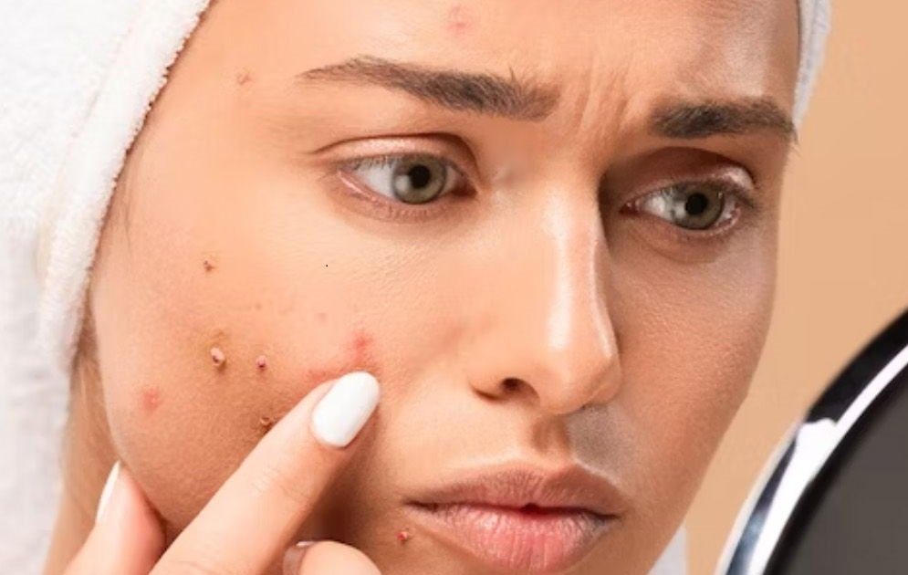 Can Old Acne Scars Be Treated?