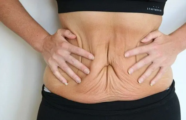 skin tightening after weight loss