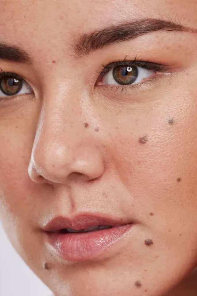 Preventing skin tags and abnormal moles