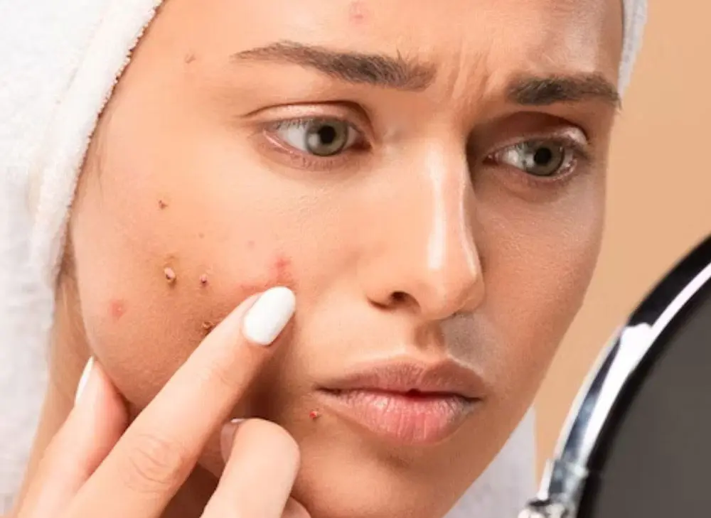 Acne scarring in Melbourne
