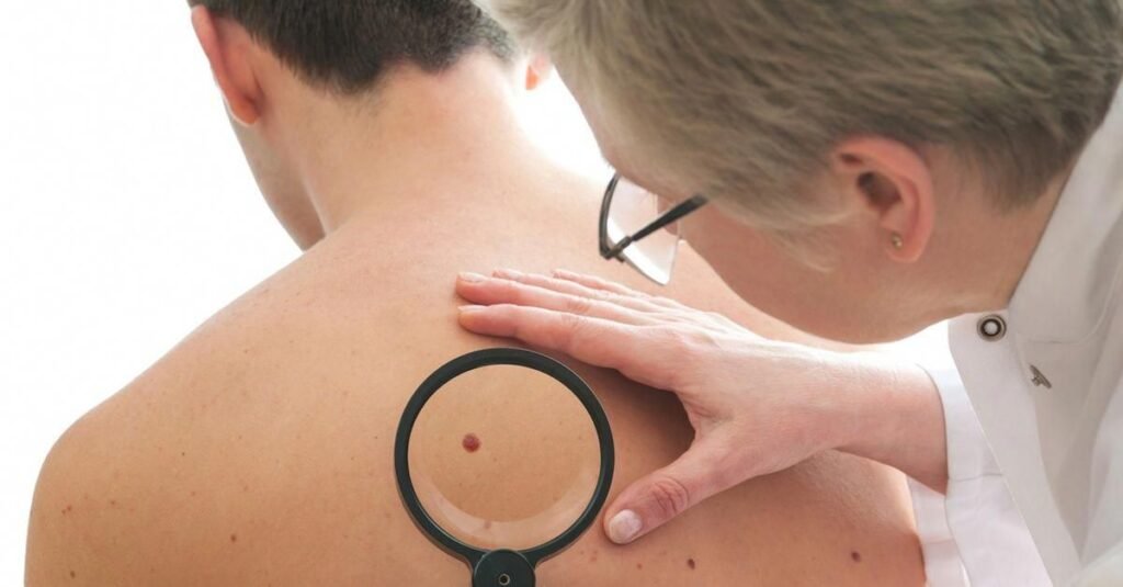 Expert Mole & Skin Tag Removal in Melbourne