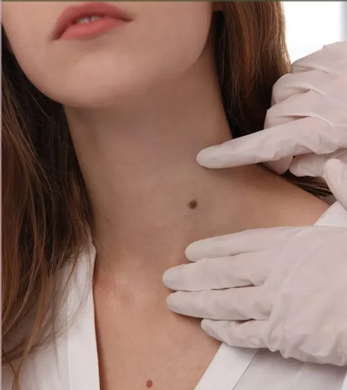 Expert skin lesion removal in Melbourne