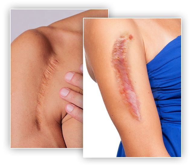 
Scars and stretch marks treatment in Melbourne