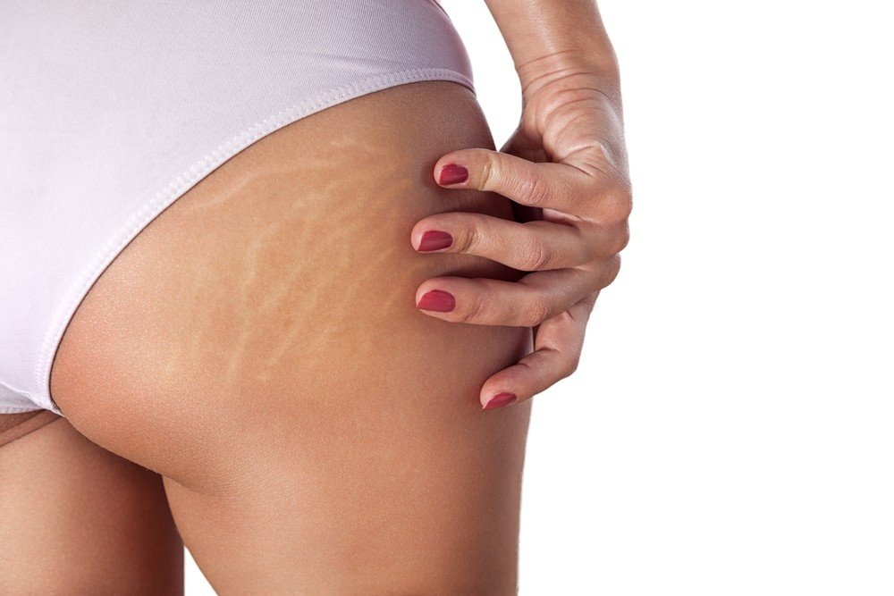 Scars and stretch marks treatment in Melbourne
