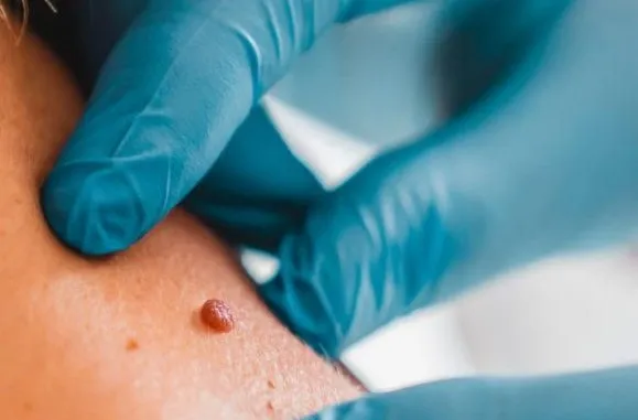 will skin tag removal leave scars