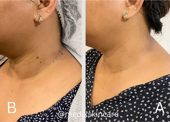 After mole removal care