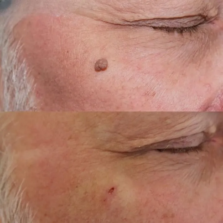 After mole removal care
