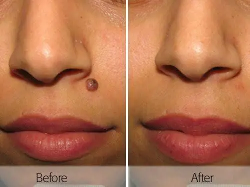 safe mole removal in Melbourne