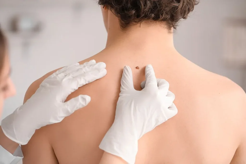 will skin tag removal leave scars