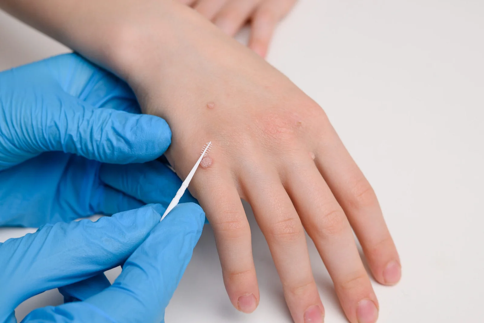 Wart Removal And Treatment Options