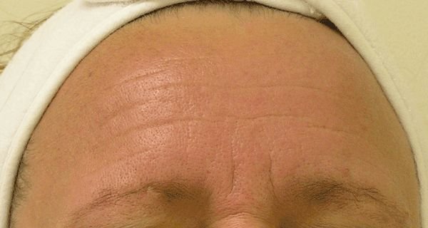 HydraFacial After Treatment