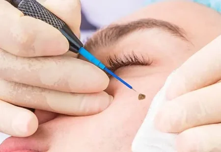 Preventing skin tags and abnormal moles