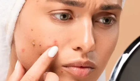 Acne scarring in Melbourne