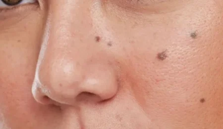 Preventing skin tags and abnormal moles