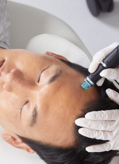 Hydrafacial for acne scars