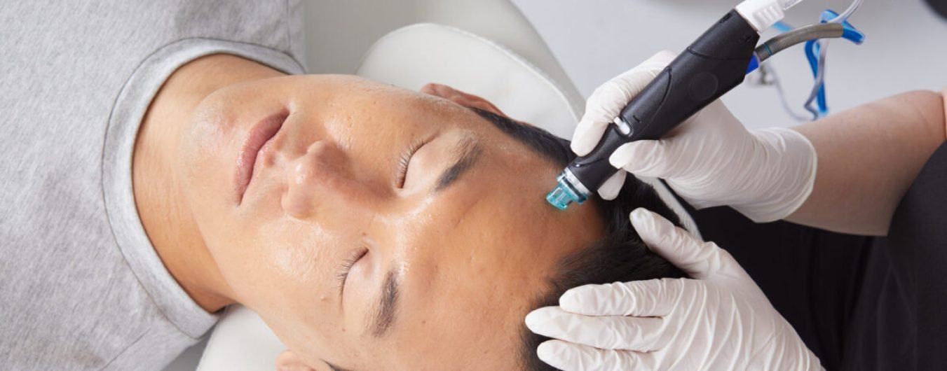 Hydrafacial for acne scars