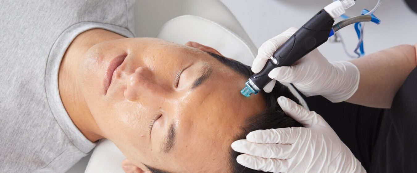 Hydrafacial for acne scars