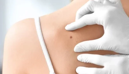 Skin tag and mole removal in Melbourne