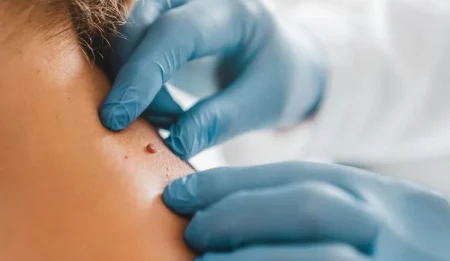 Difference between skin tags and moles