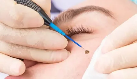 skin tags grow back after removal