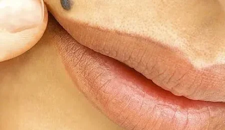 safe mole removal in Melbourne