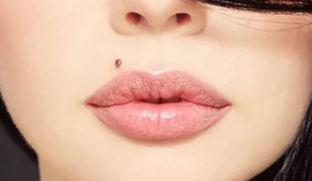 safe mole removal in Melbourne