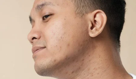 Alt Text: Advanced clinical acne scar treatment consultation at Medix Skincare Melbourne